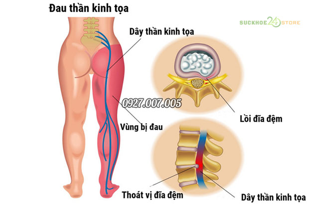 đau dây thần kinh toạ