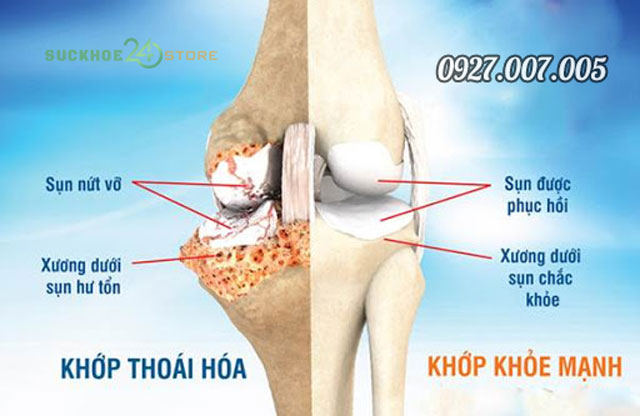 thoái hoá khớp