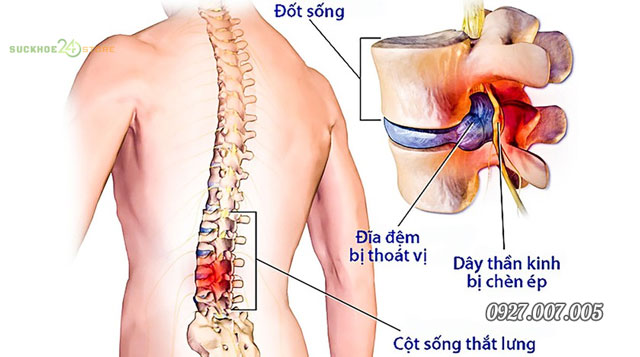 thoát vị đĩa đệm