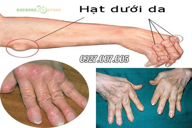 viêm khớp dạng thấp